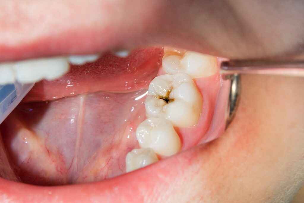 tooth decay treatment in Kearny Mesa