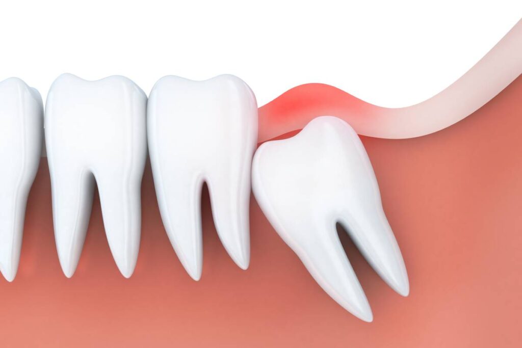 Wisdom Teeth Removal: When is it Necessary