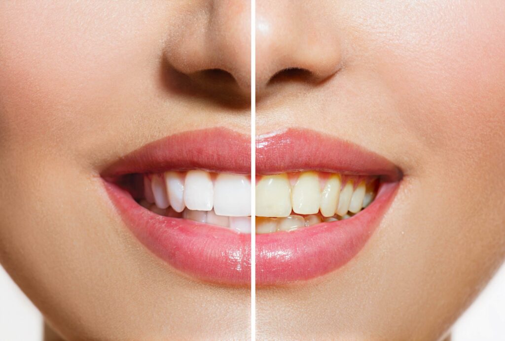 Teeth Whitening: What’s Involved