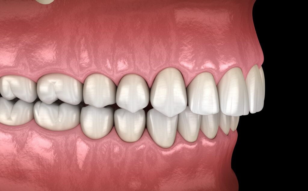 Overbite dental occlusion ( Malocclusion of teeth )