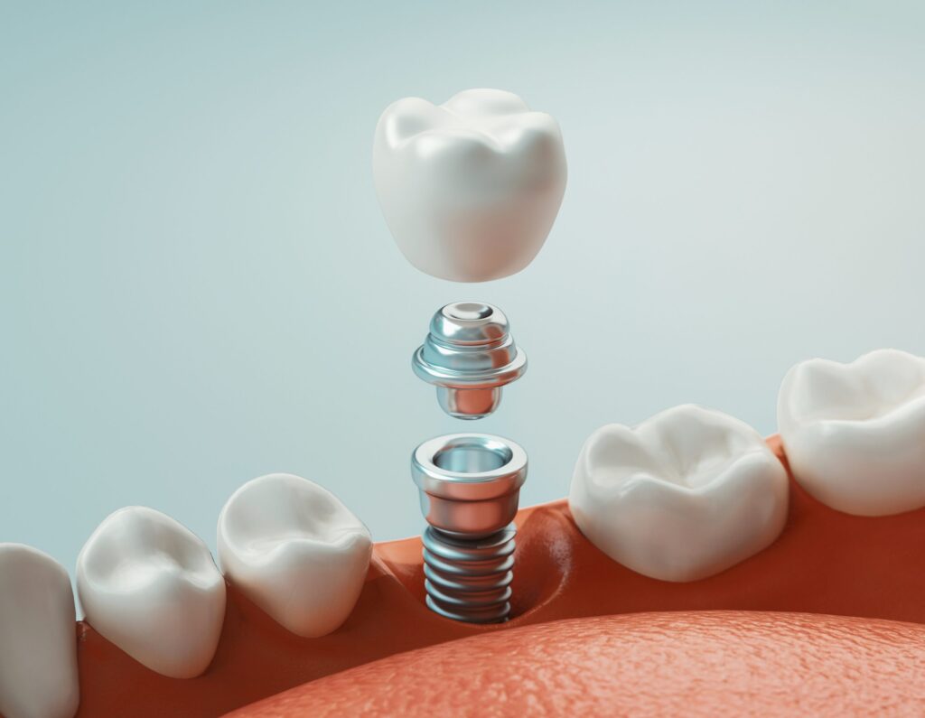 Dental Implant Care and Maintenance