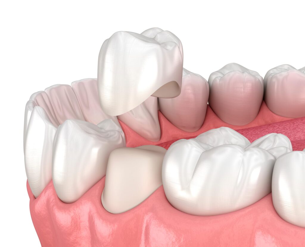 What to Expect When Getting a Dental Crown