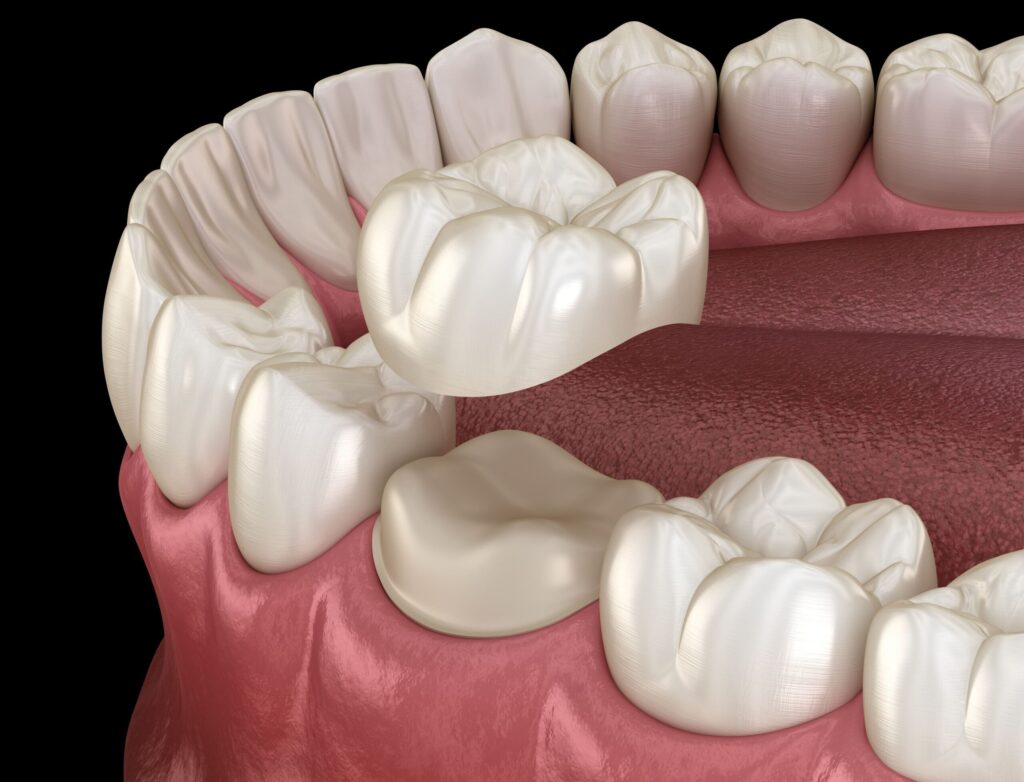 The Complete Guide to Dental Crowns: When and Why You Need One