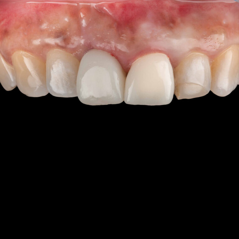 single-tooth-over-implant-after