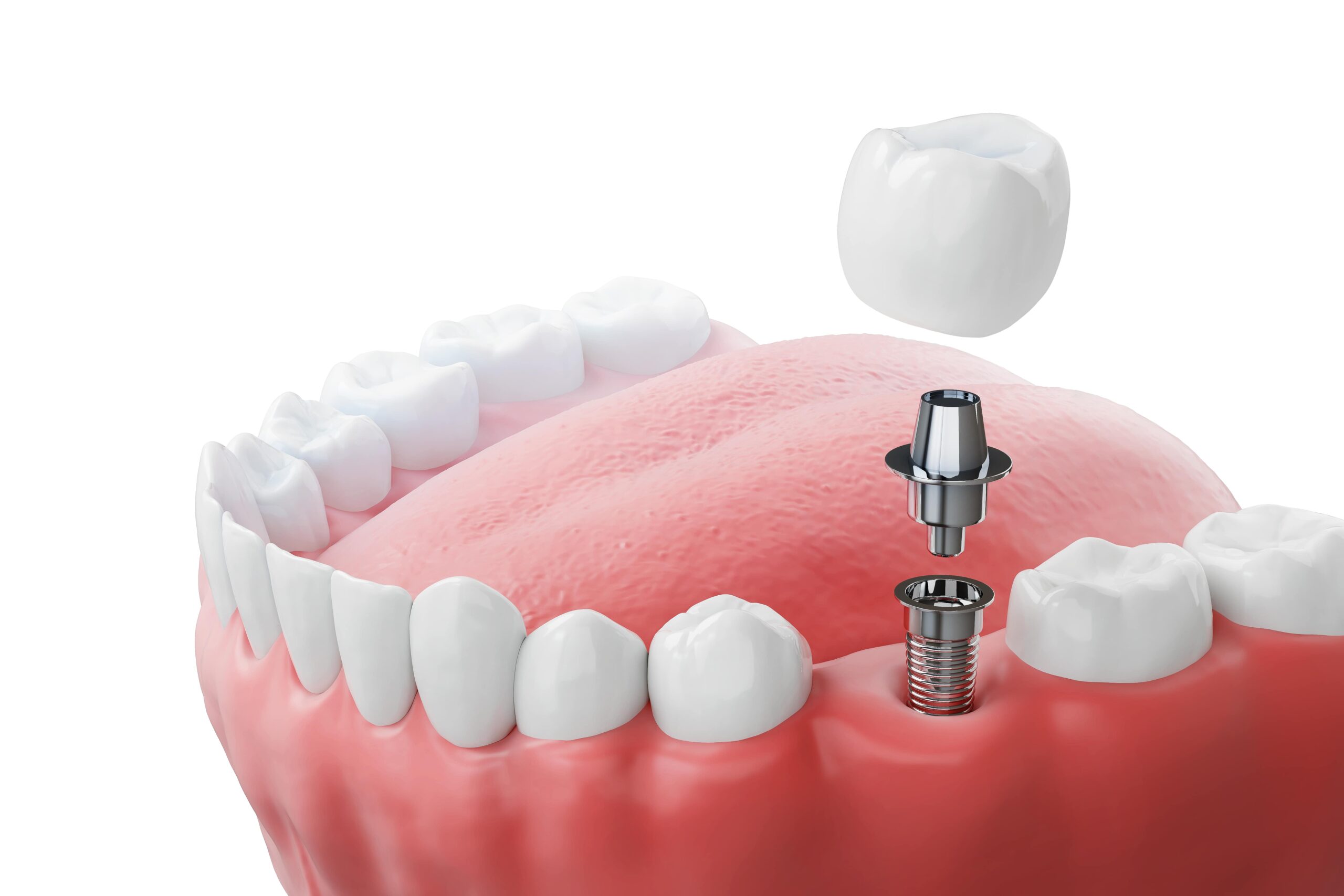 Signs Your Dental Implant Needs to Be Repaired