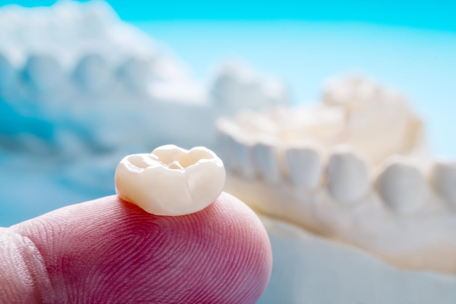 How to Care for Your Dental Crowns: Maintenance and Longevity